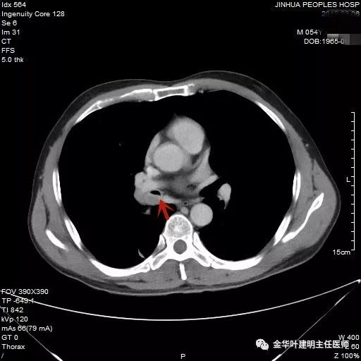 省级医院也漏诊?还好没耽误病情!我们予以行右中下叶袖式切除术