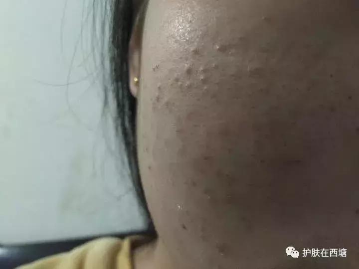 为什么额头上的痘痘反反复复,十几年的痘痘反反复复怎么办