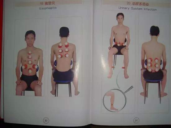 拔罐有哪些穴位图解,最全拔罐穴位疗法图解