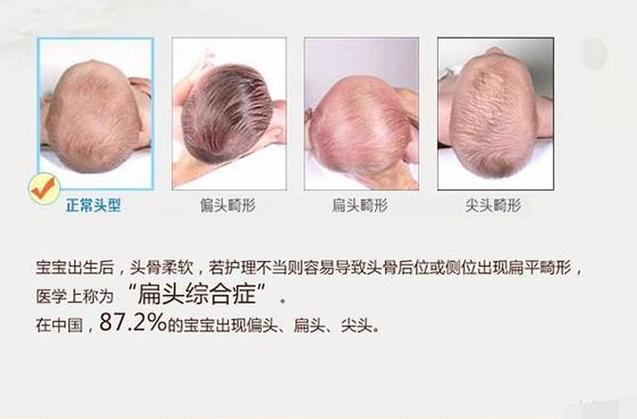 宝宝头型睡扁如何纠正,青年扁头可以通过睡姿矫正吗