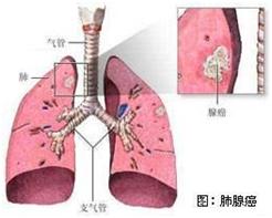 肺癌定义、病因、病理及病理组织学分类