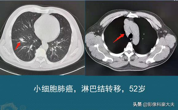 肺癌晚期胃癌,肺癌和胃癌晚期的状况
