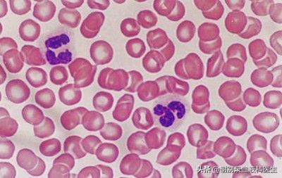 谢别录治疗白血病,谢别录治疗血液病效果怎么样