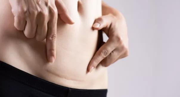 剖腹产刀口增生期怎么护理,剖腹产刀口增生以后怎么护理