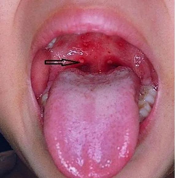 手足口病的预防与护理温馨提示,幼儿手足口病预防知识