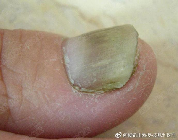 小小的指甲隐藏大大的健康秘密,小小指甲大调查