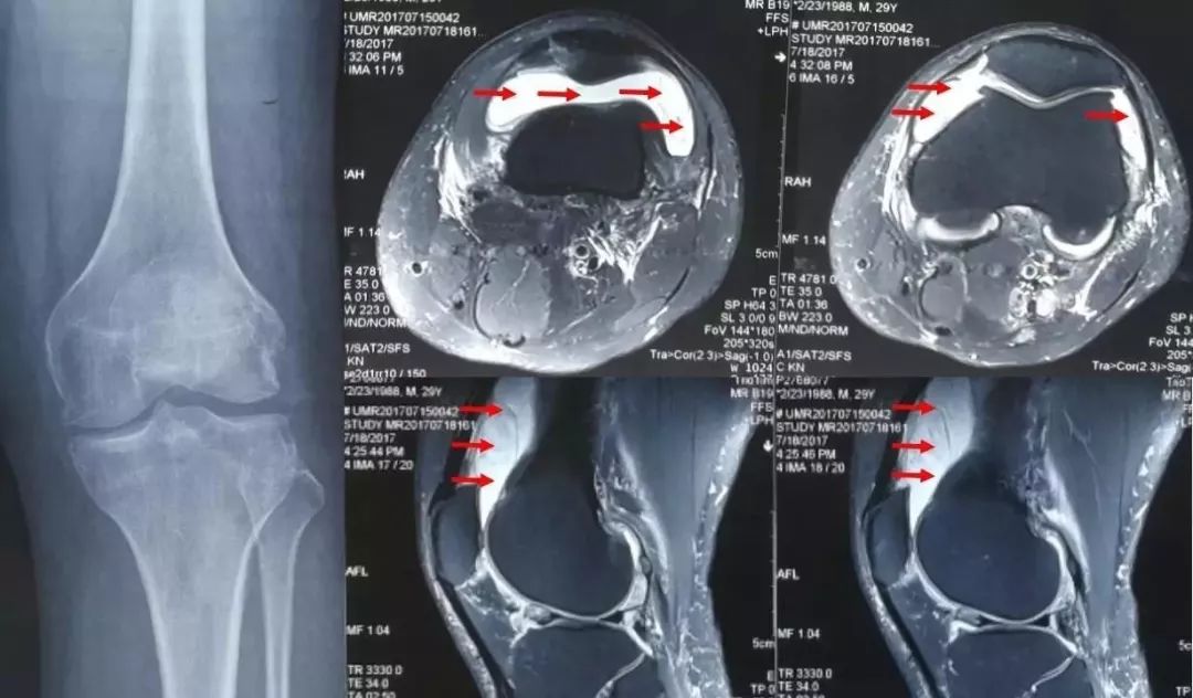 滑膜炎十大常见骨科疾病,骨科专家治滑膜炎偏方