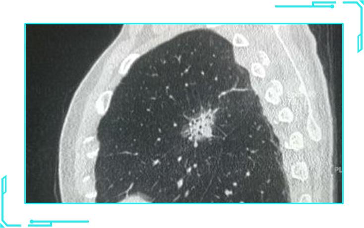 肺结节7mm需要做肺癌抗体7项,肺结节高危与早期肺癌的区别