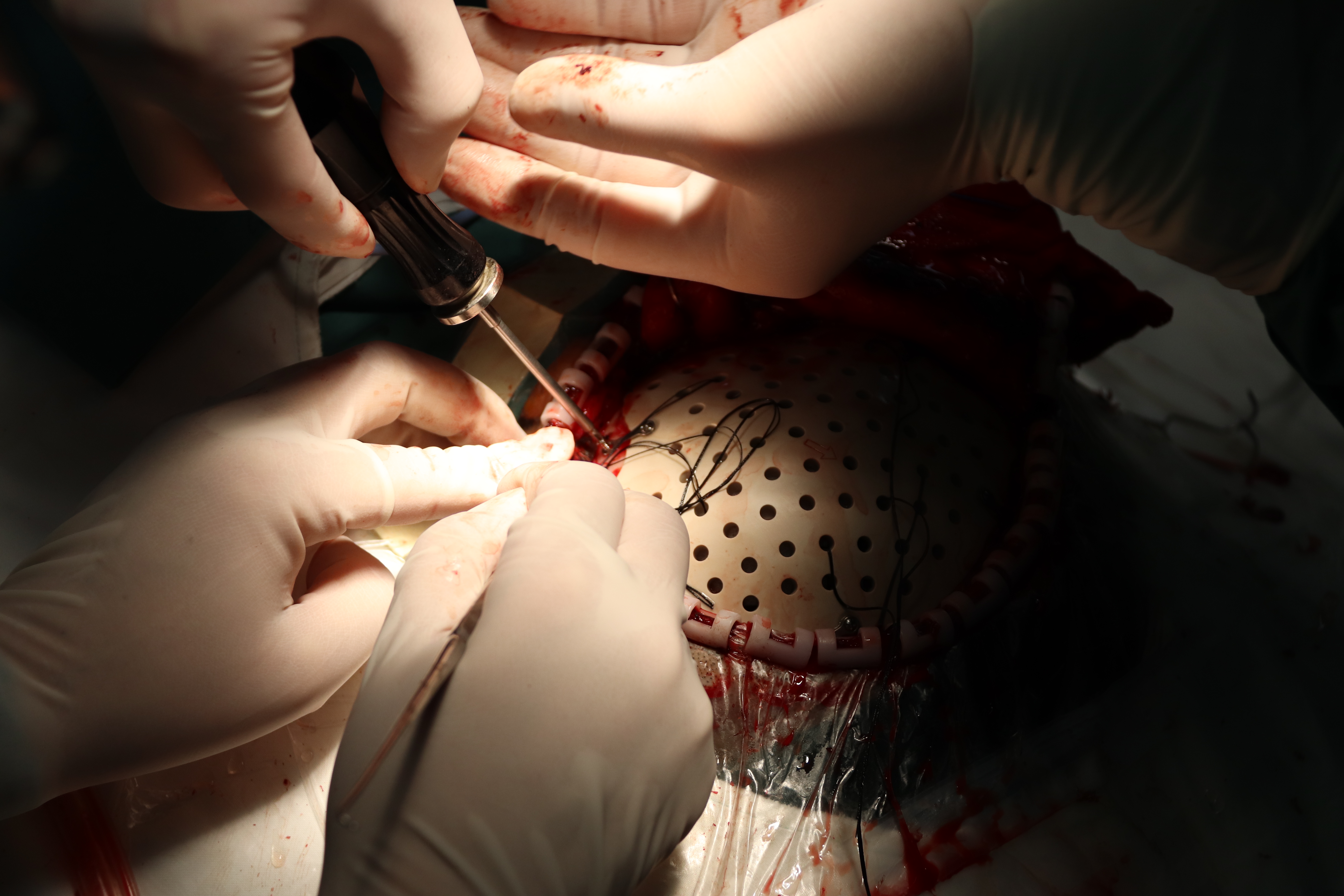 自体颅骨修补颅骨流失的几率大吗,颅骨缺损不修补的危害