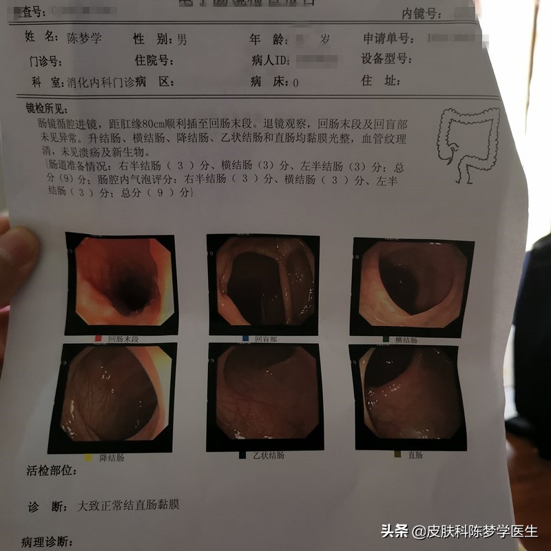 做无痛胃肠镜的真实感受,无痛胃肠镜经历