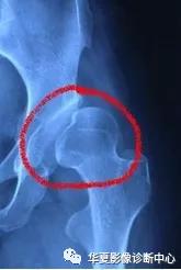 先天性髋关节脱位,先天性髋关节脱位属不属于残疾人