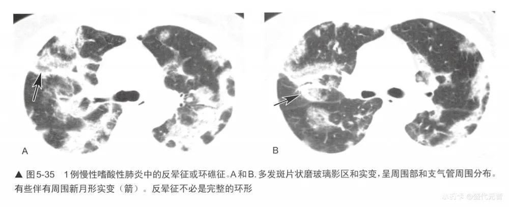 肺HRCT图像特征是什么,肺hrct诊断思路