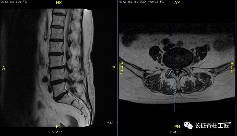 老年人腰椎管狭窄可以微创手术吗,老年人腰椎管狭窄瘫痪