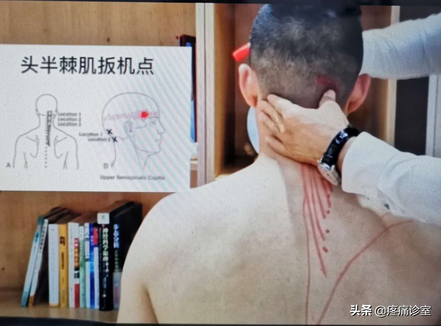 我的偏头痛怎么治好的,我的偏头痛一年多了反复发作