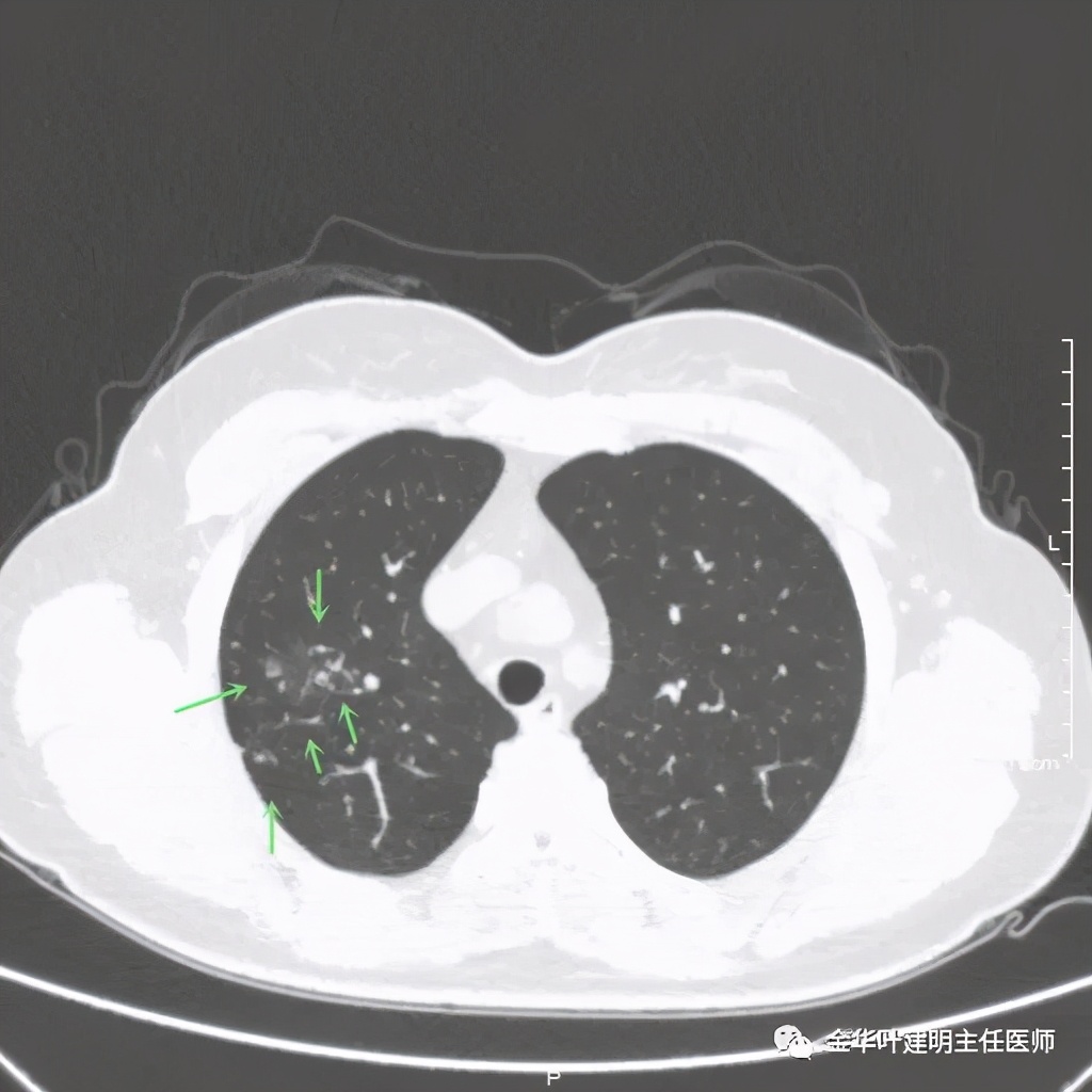 右上肺结节灶一般是什么癌,右上肺恶性肿瘤是肺癌吗