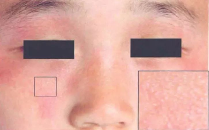 发热出红疹子可以吃过敏药吗,发热皮疹会反复么