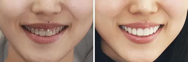 花1000块洗牙美白，效果输给一支烟民牙膏！新西兰人用它白了97年