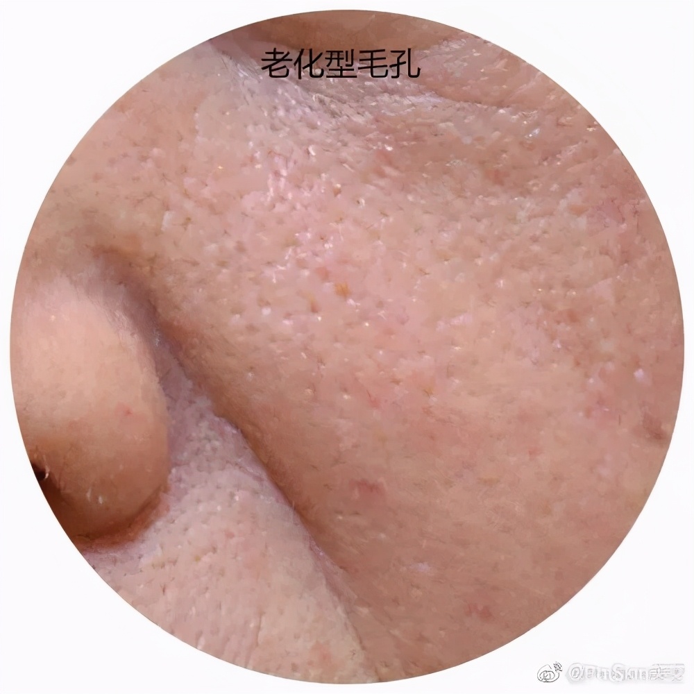 皮肤蜡黄粗糙毛孔粗大喝什么调理,皮肤科黑头粉刺毛孔粗大怎么调理