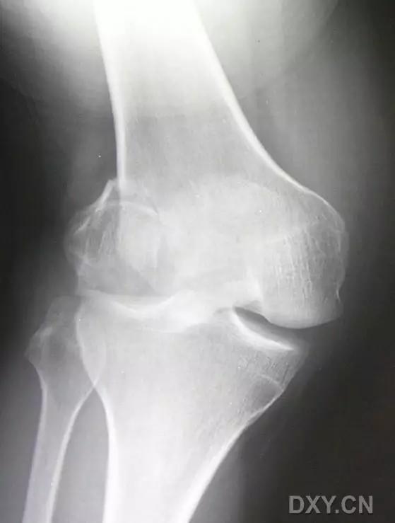 特殊骨折类型,特殊骨折体征