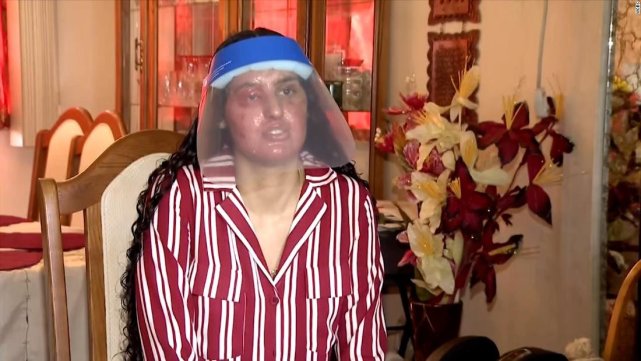 纽约一穆斯林女大学生遭陌生人泼电池酸液,严重烧伤恐永久失明