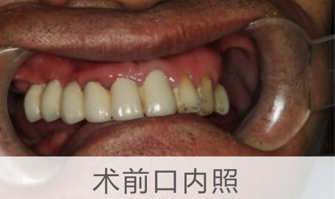 老年人半口缺牙有几种修复方法,老年人大部分缺牙的最佳治疗方法