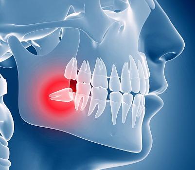 口腔智齿,智齿拔除后怎么处理智齿