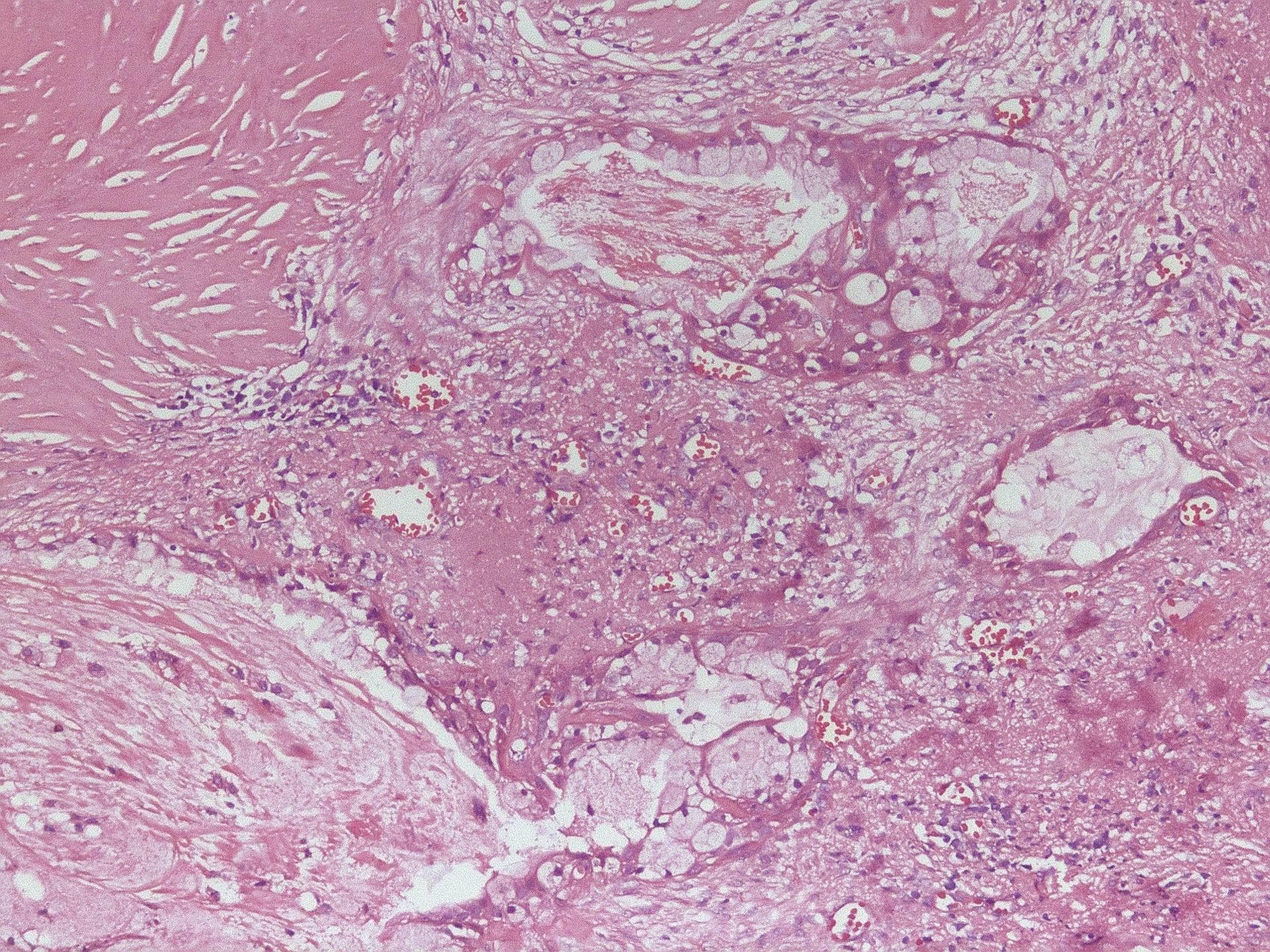 黏液表皮样癌是一种恶性肿瘤，侵犯面神经可引起腮腺的面神经麻痹