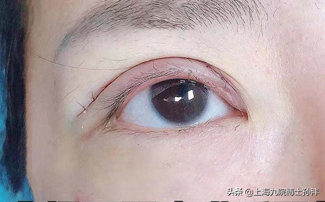 九院博士孙沣：眼部干瘪松弛线条凌乱，其实全切就能很好解决