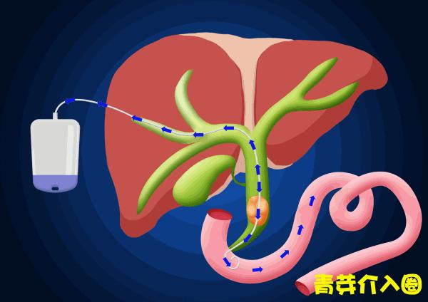 胆道阻塞眼睛发黄图片,胆管堵塞全身发黄中医治疗