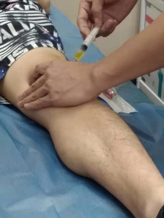 富血小板血浆治疗骨头坏死,林子洪医师