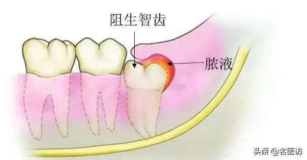 拔智齿：讳疾忌医有什么后果？