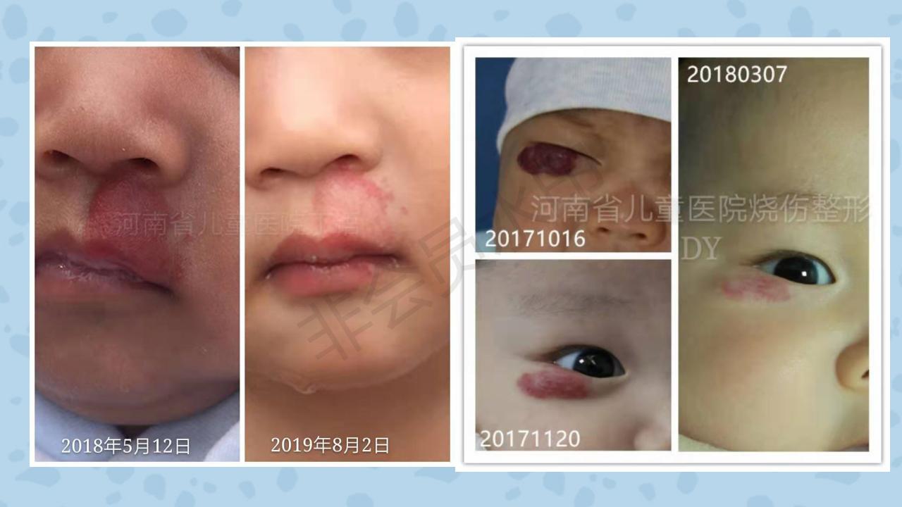 老人血管瘤需要治疗吗,皮肤血管瘤需要治疗吗