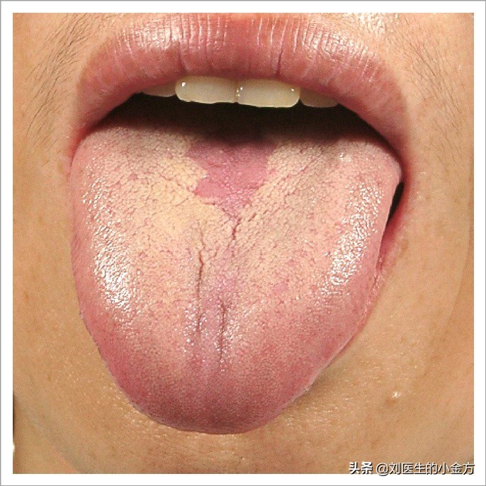 中医舌诊图解100例,中医舌诊图与舌诊口诀