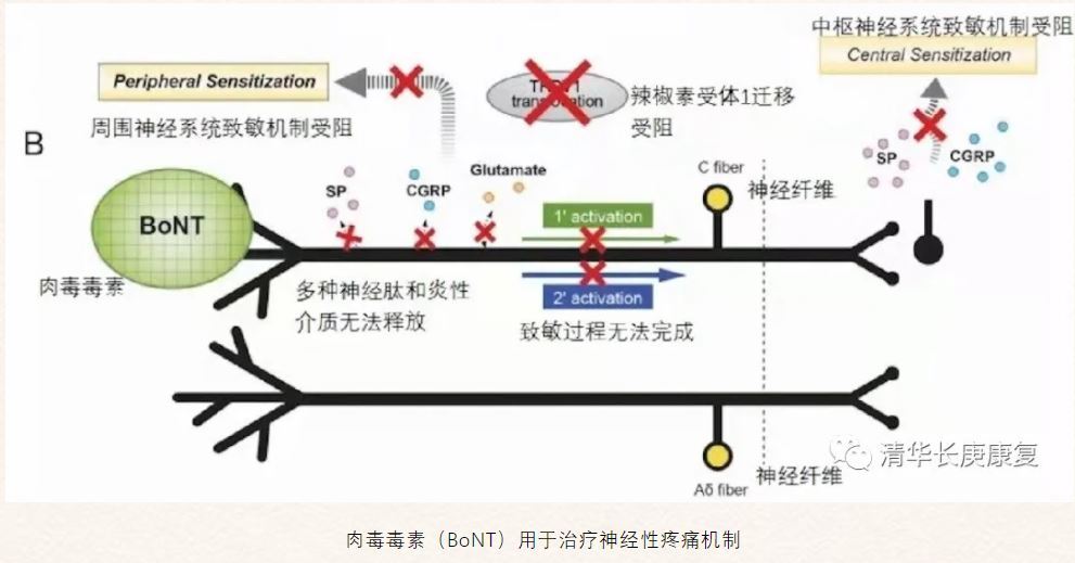 疼痛性带状疱疹,带状疱疹后遗神经痛引发胯骨疼痛