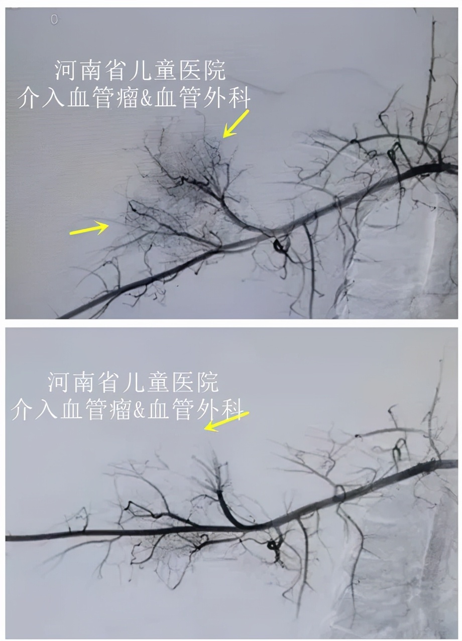 婴儿打预防针胳膊发青怎么办,婴儿打预防针手臂发紫