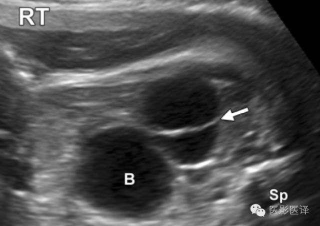 孕早期卵巢囊肿边界清形态规则,孕期卵巢囊肿呈液性伴点状回声