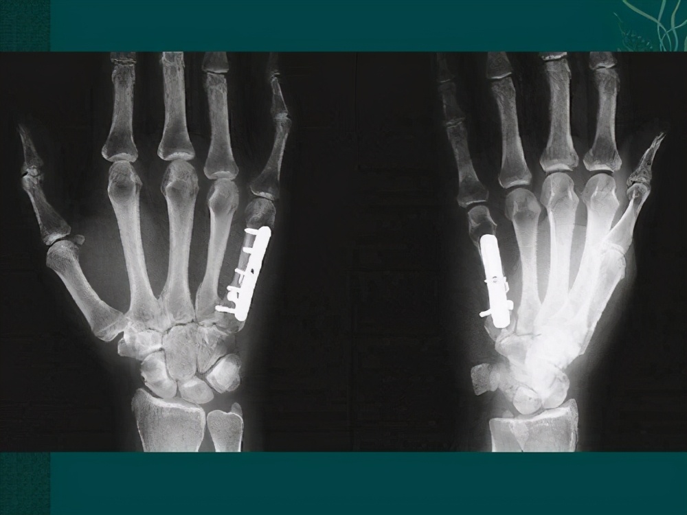 骨折上的钉还用取出来吗,骨折放的钢板是铁的吗