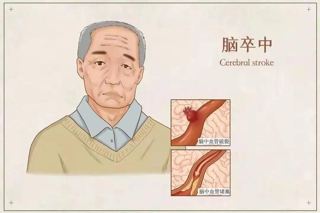 安宫牛黄丸对脑梗有效吗,一年哪4天吃安宫牛黄丸