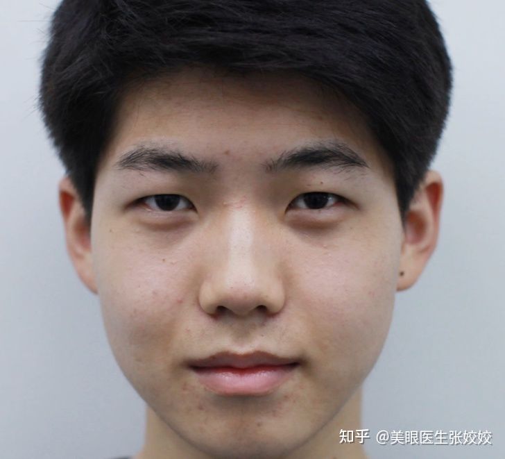 男生做双眼皮是全割还是埋线,男生肉眼泡双眼皮手术