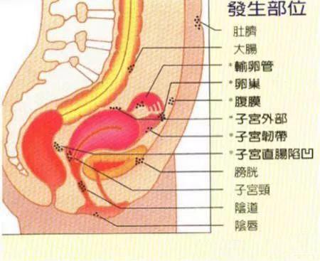 她用医生教的方法，查出体内有妇科肿瘤，救了自己一命