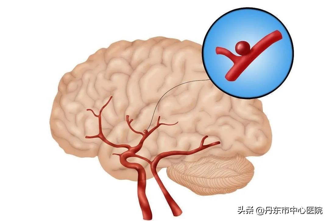 脑血管病的治疗科普,高血压颈动脉硬化缺血性脑血管病