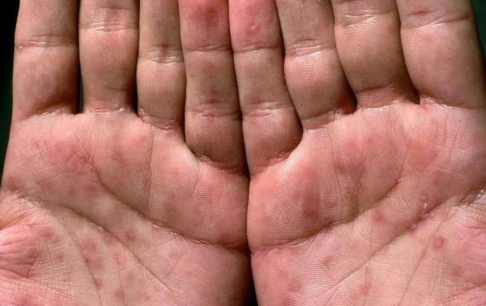 性病有哪些症状?医生:学会自查很重要,教你“望触摸”3个技巧