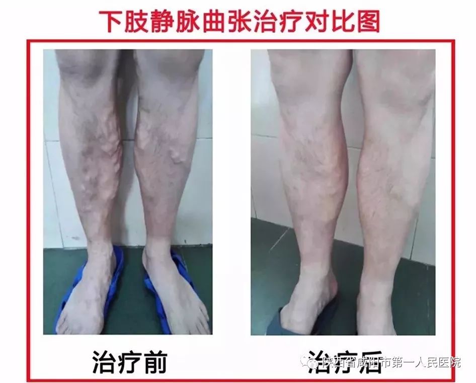 下肢静脉曲张微创手术是什么手术,下肢静脉曲张微创手术优点和缺点