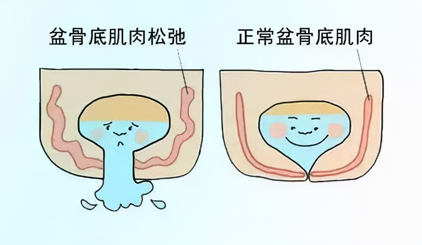 门医动态|好消息！泌尿外科增设女性尿*禁失**专病门诊