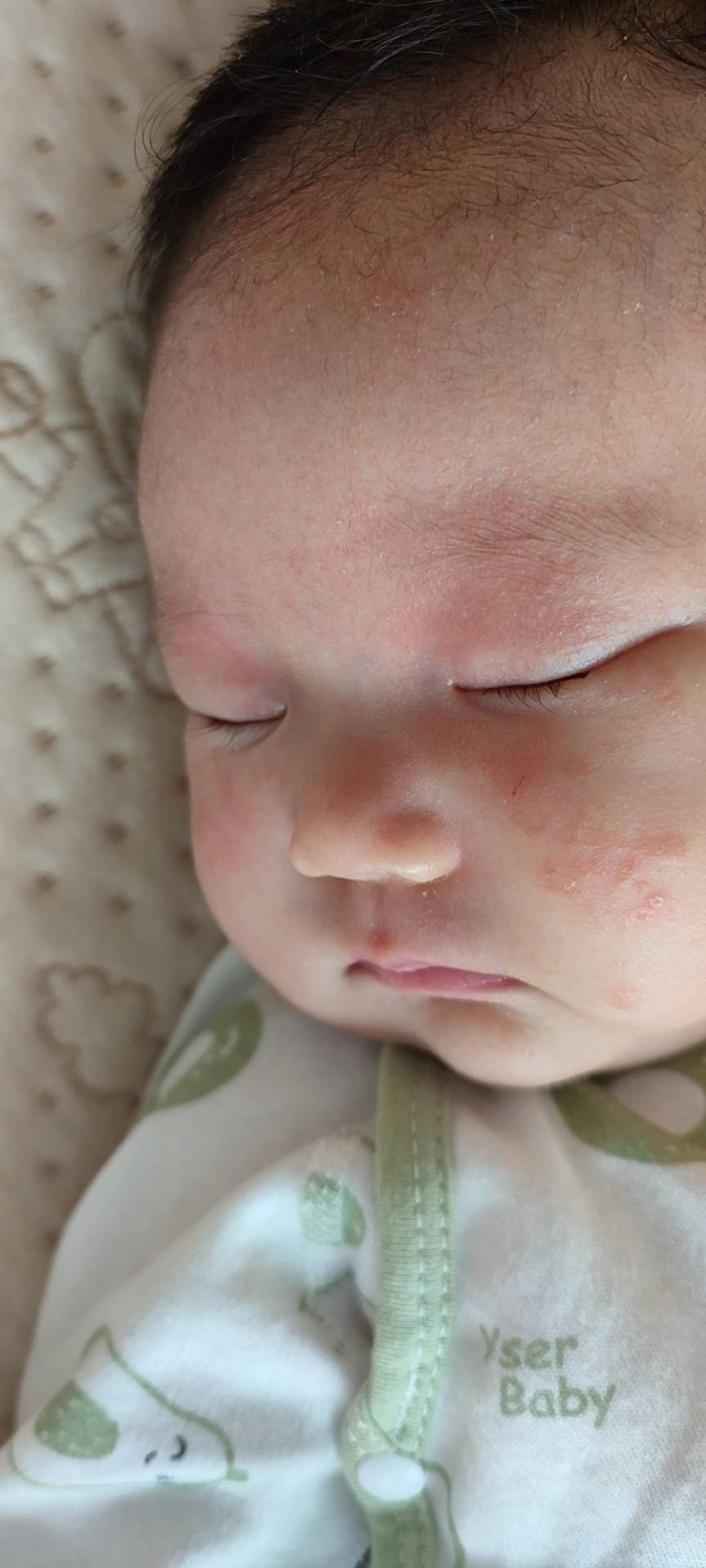 宝宝大作战8-9,宝宝湿疹大作战