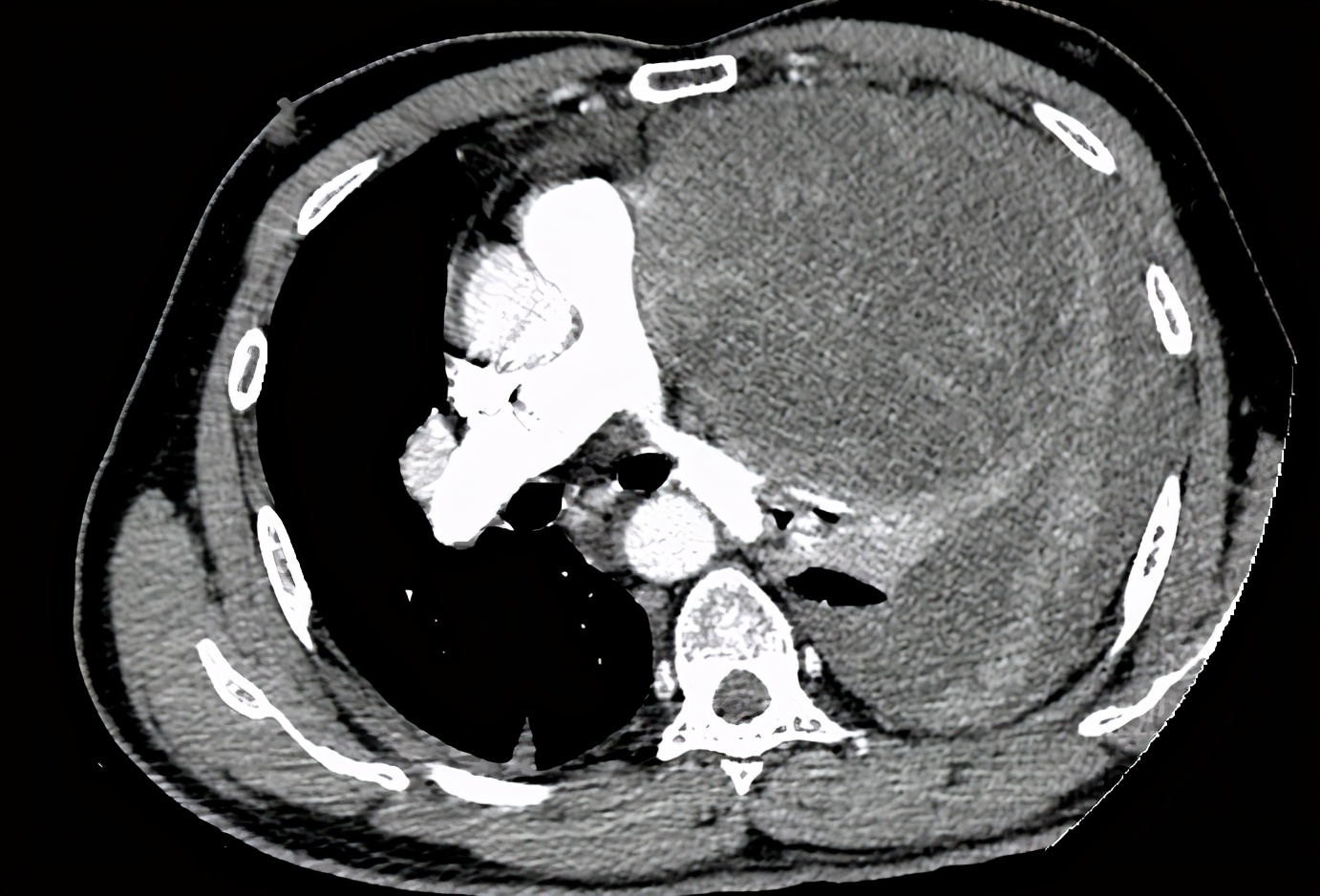 巨大肿瘤切除手术生命缘,巨大肿瘤被医生成功切除
