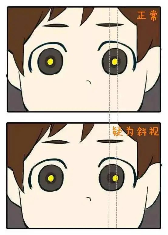 孩子总是侧头看东西？斜视治疗不及时可能失去视功能