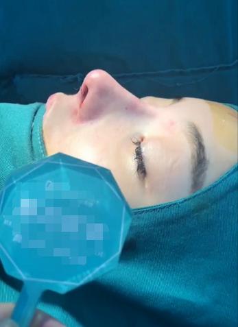 肋骨隆鼻最快的恢复方法,肋骨隆鼻即刻效果