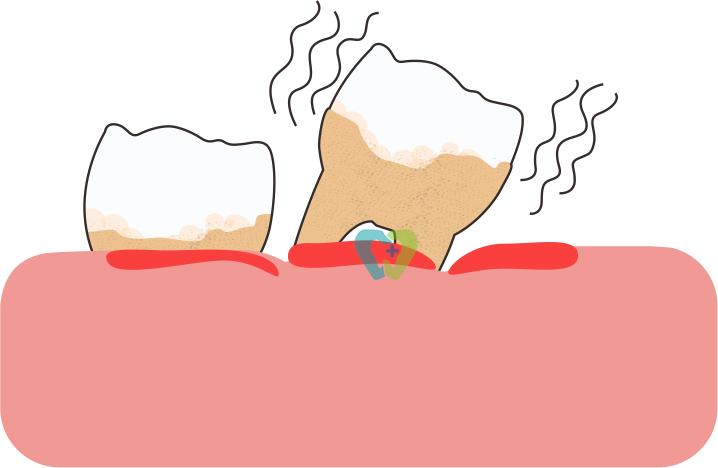 梦里牙齿松动自己拔掉,儿童牙齿松动怎么拔掉