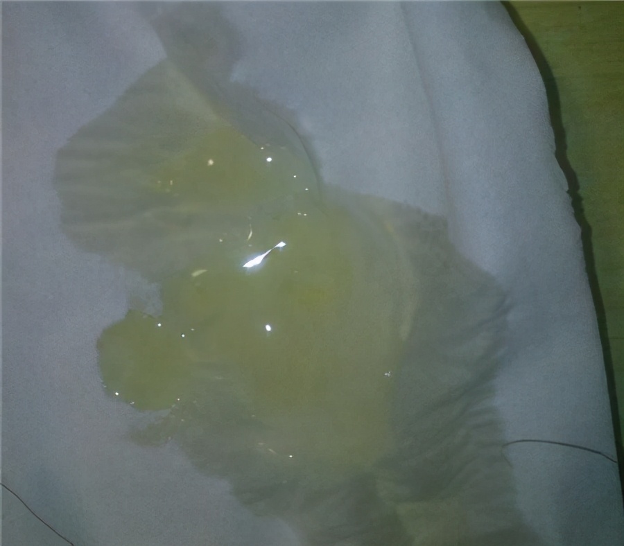 男性的精子为什么有的成块状,男性的精子呈褐色正常吗